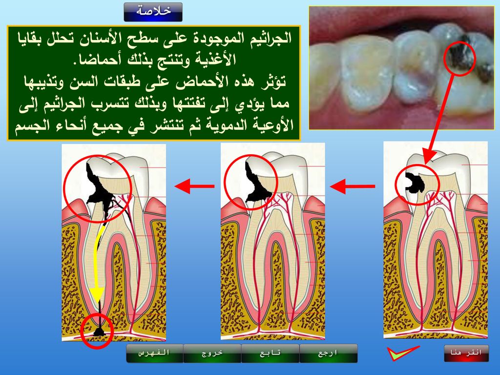 اعتمادا على الوثائق السابقة والصور التالية، اشرح كيف يتم نخر الأسنان