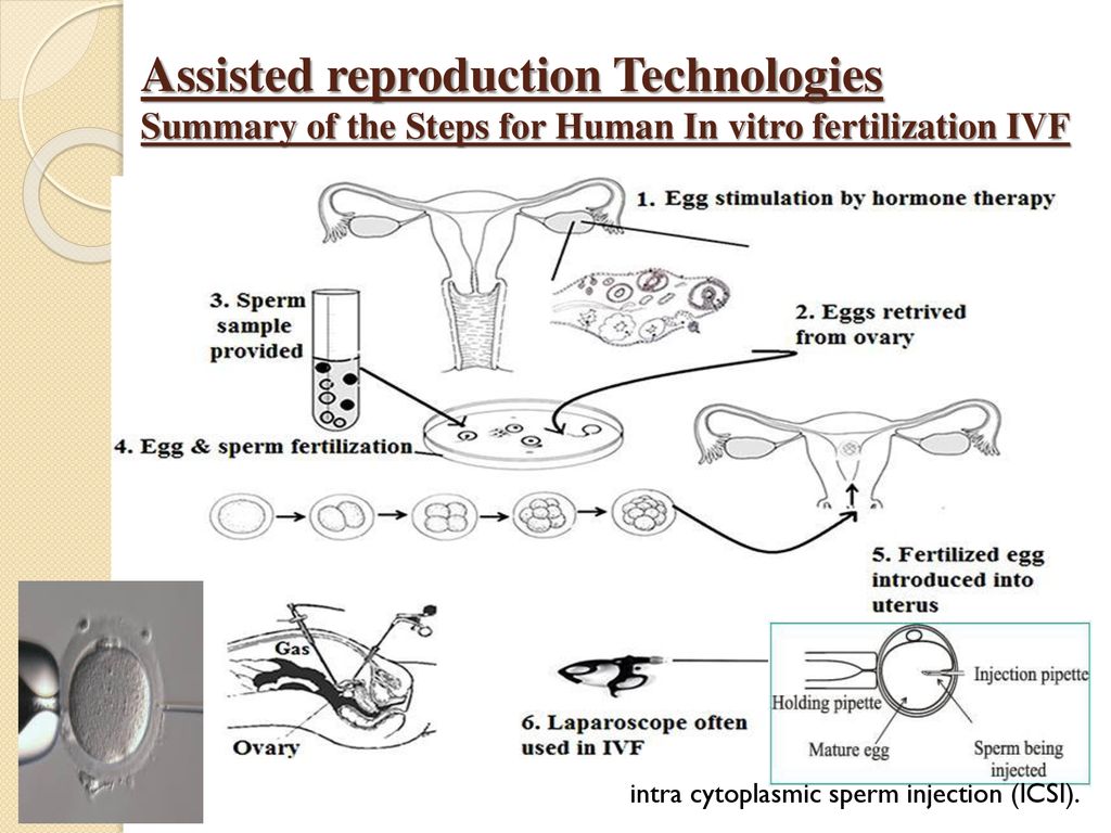 Assisted reproduction Technologies Summary of the Steps for Human In vitro fertilization IVF