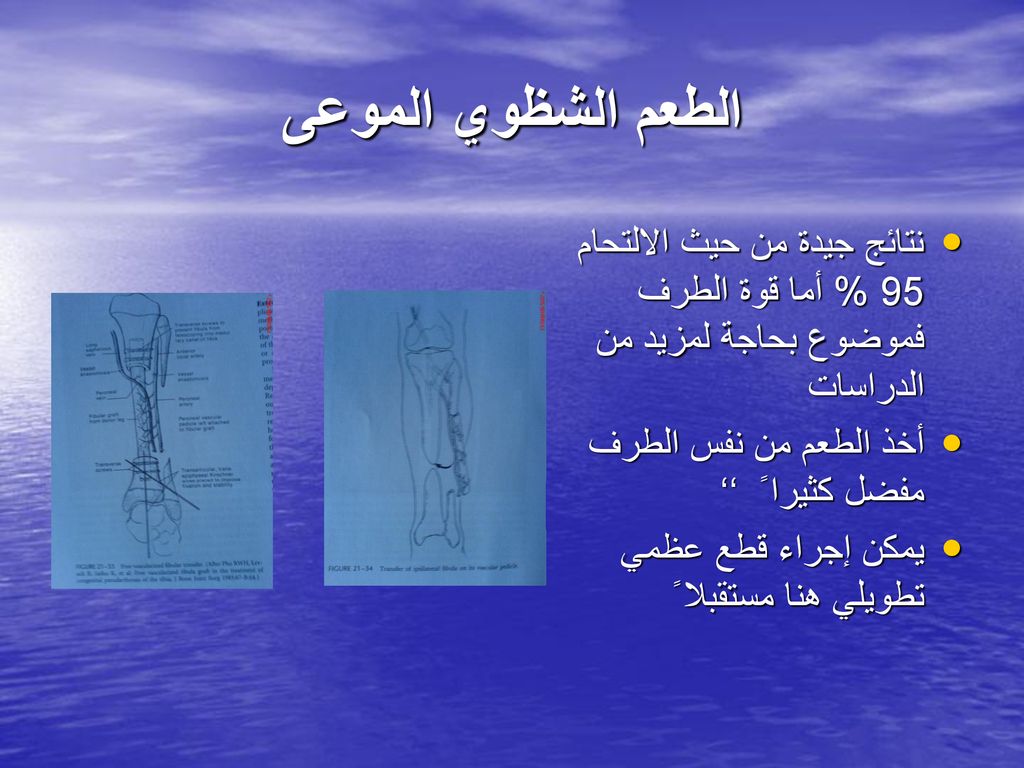 الطعم الشظوي الموعى نتائج جيدة من حيث الالتحام 95 % أما قوة الطرف فموضوع بحاجة لمزيد من الدراسات. أخذ الطعم من نفس الطرف مفضل كثيرا ً ‘‘