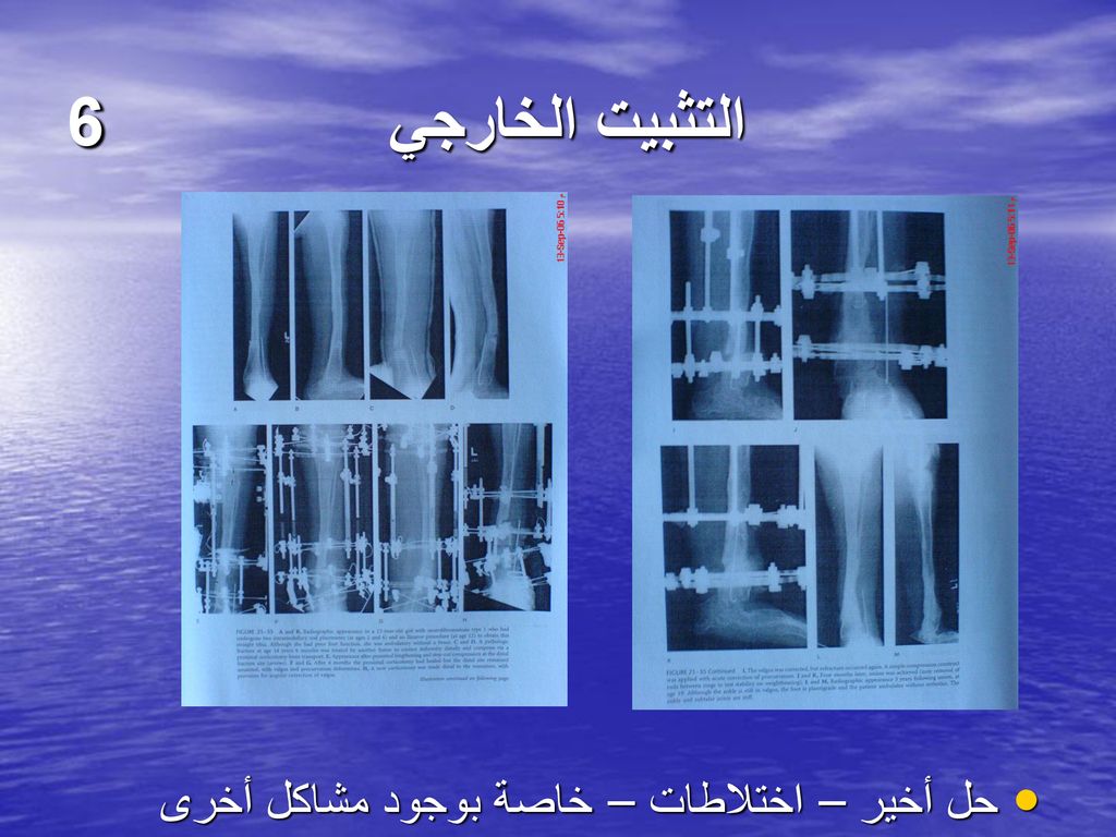 التثبيت الخارجي 6 حل أخير – اختلاطات – خاصة بوجود مشاكل أخرى