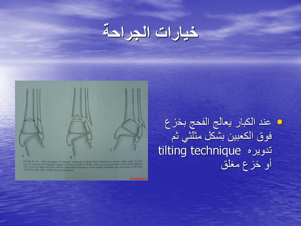 خيارات الجراحة عند الكبار يعالج الفحج بخزع فوق الكعبين بشكل مثلثي ثم تدويره tilting technique أو خزع مغلق.