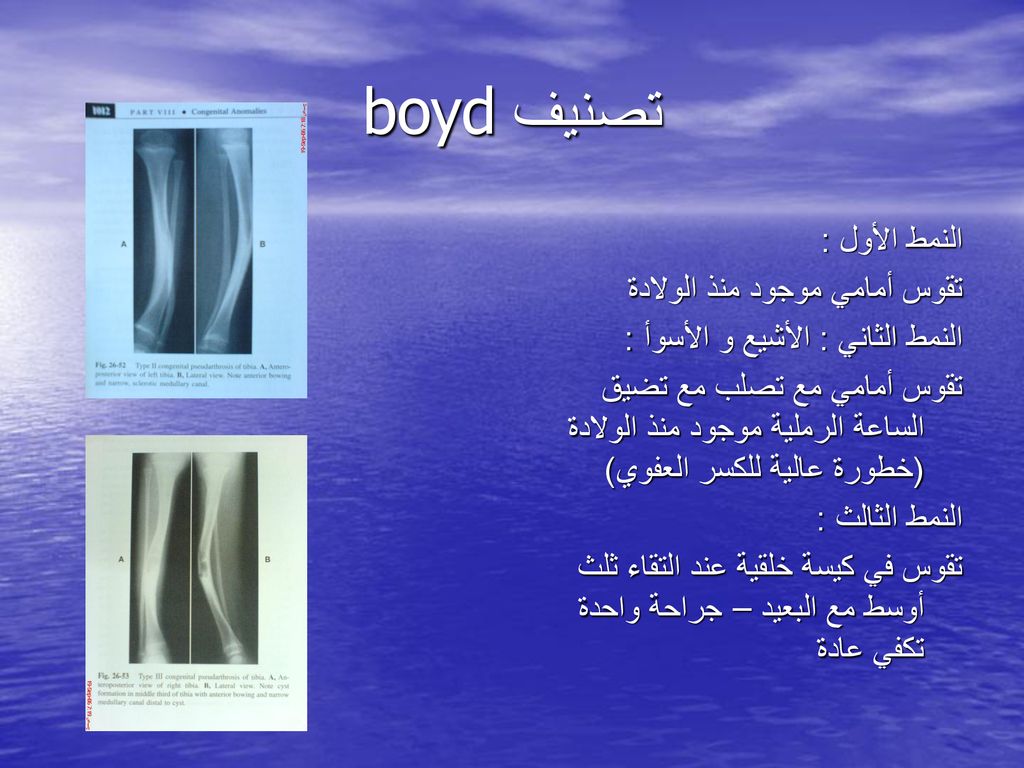 تصنيف boyd النمط الأول : تقوس أمامي موجود منذ الولادة